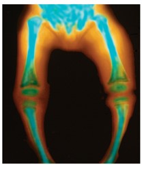 X-ray of child's legs, showing significant bending